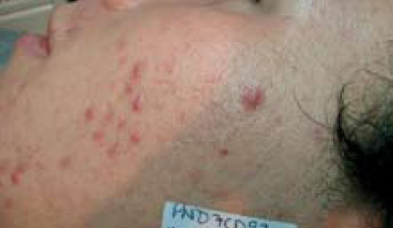 Acne BEFORE