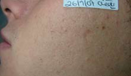 Acne AFTER