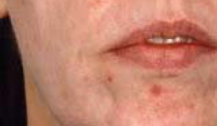 Acne AFTER