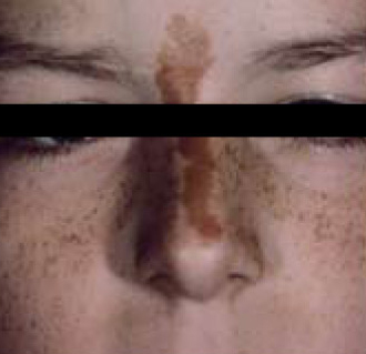 Pigment Removal BEFORE