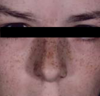 Pigment Removal AFTER