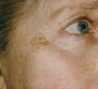 Pigment Removal BEFORE