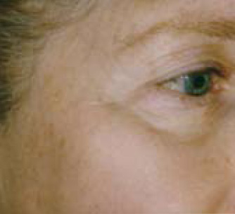 Pigment Removal AFTER