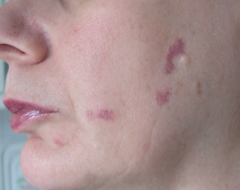 Red Vein Removal BEFORE
