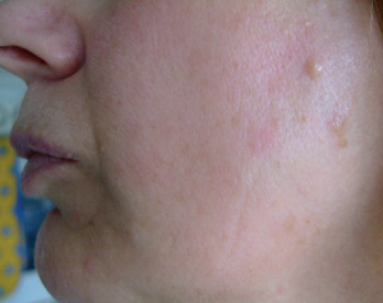Red Vein Removal AFTER