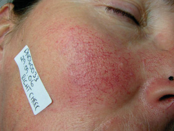 Red Vein Removal BEFORE