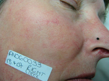 Red Vein Removal AFTER