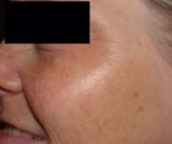 Skin Rejuvenation BEFORE