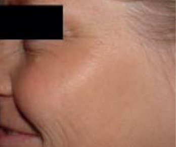 Skin Rejuvenation AFTER