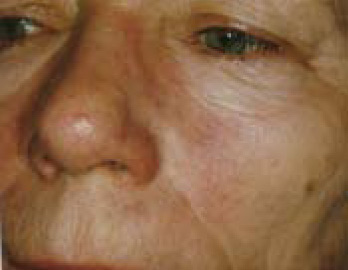 Skin Rejuvenation BEFORE