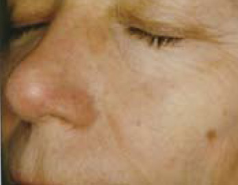Skin Rejuvenation AFTER