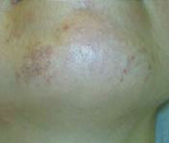 Skin Rejuvenation BEFORE