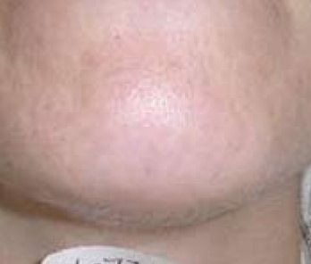 Skin Rejuvenation AFTER