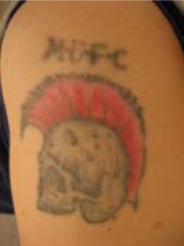 Tattoo Removal BEFORE