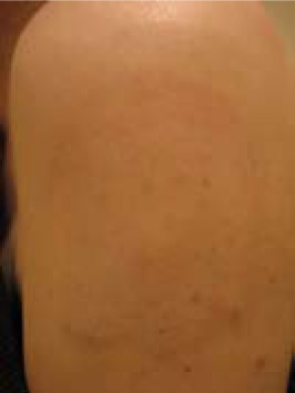 Tattoo Removal AFTER